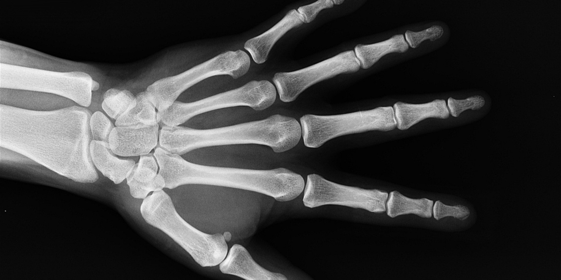 x-ray image of a hand